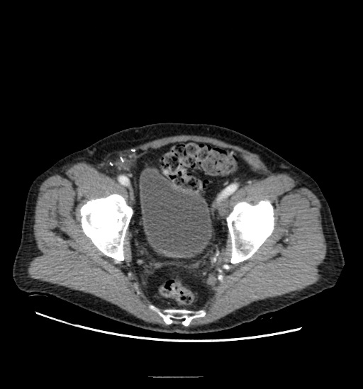 File:Appendicitis with localized perforation and abscess formation (Radiopaedia 49035-54130 A 77).jpg