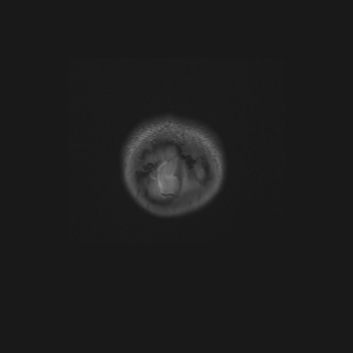 Aqueduct stenosis (Radiopaedia 52453-58460 Coronal T2 1).jpg