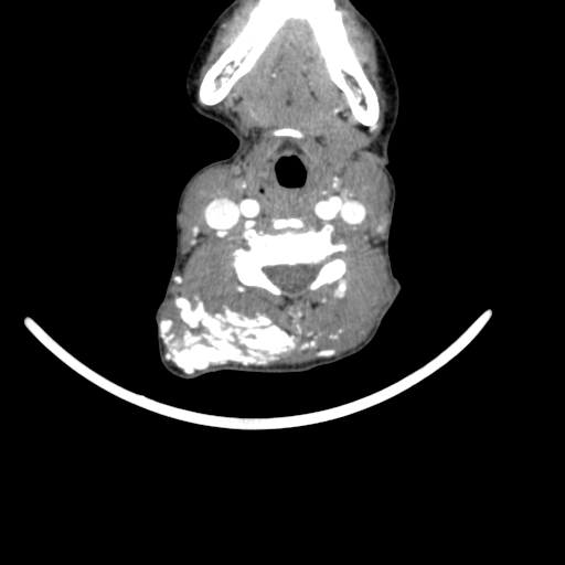 Arteriovenous malformation of the neck (Radiopaedia 53935-60062 A 29).jpg