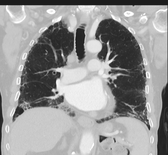 File:Asbestosis (Radiopaedia 56192-62864 Coronal lung window 27).png