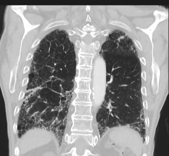 Asbestosis (Radiopaedia 56192-62864 Coronal lung window 39).png