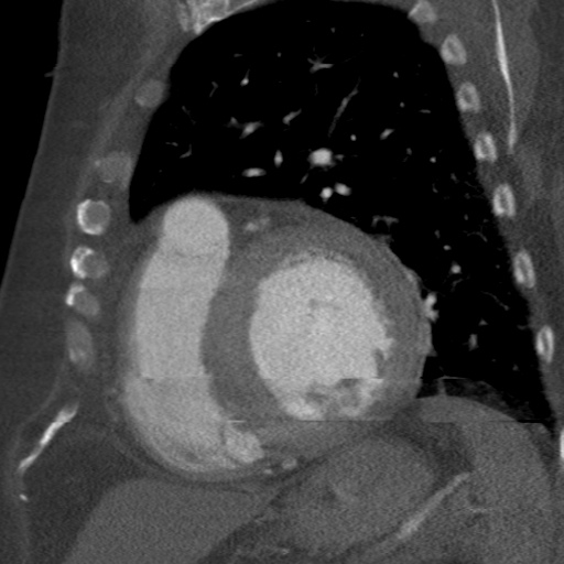 File:Ascending aortic aneurysm (Radiopaedia 20913-20846 A 4).jpg