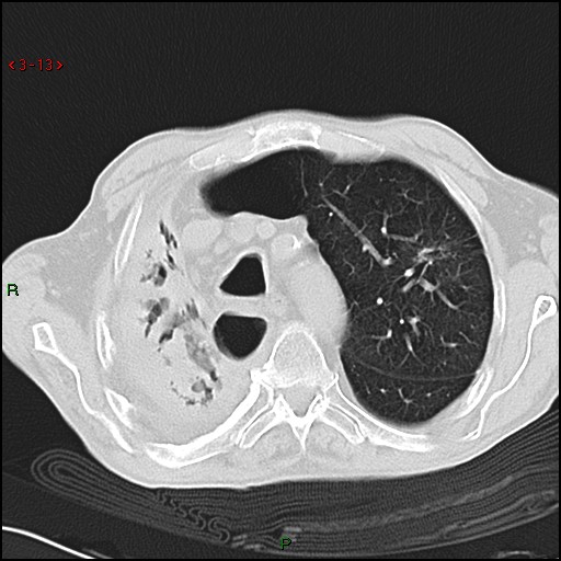 File:Aspergilloma (Radiopaedia 14842-14787 Axial lung window 13).jpg