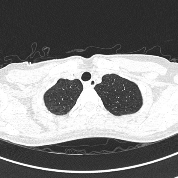 Aspergilloma (Radiopaedia 26223-26347 Axial lung window 10).jpg