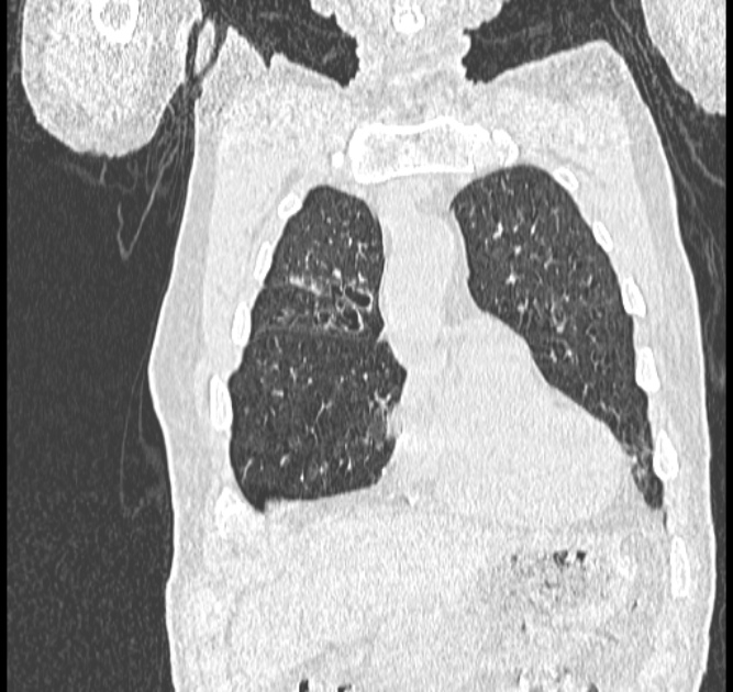 Aspergilloma (Radiopaedia 44592-48327 Coronal lung window 20).jpg