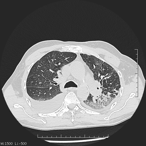 Aspergilloma (Radiopaedia 75184-86270 Axial lung window 18).jpg