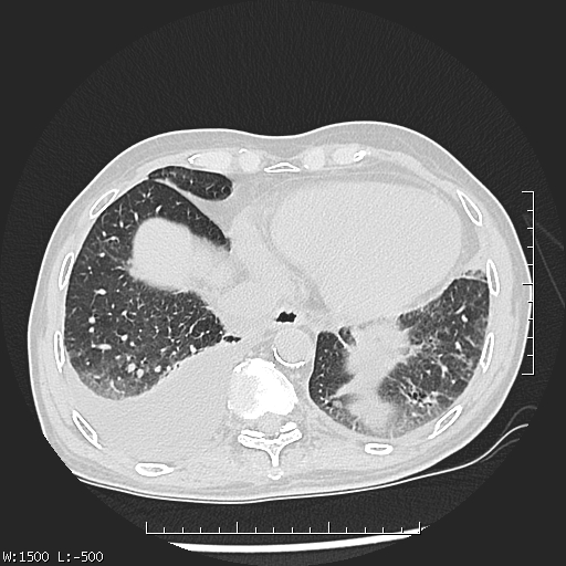 Aspergilloma (Radiopaedia 75184-86270 Axial lung window 43).jpg