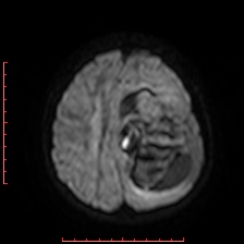 Astroblastoma (Radiopaedia 74287-85162 Axial DWI 78).jpg
