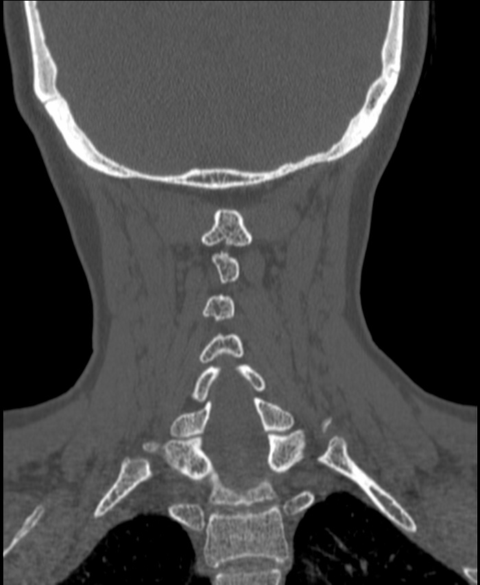 Atlanto-occipital assimilation with basilar invagination (Radiopaedia 70122-80188 Coronal bone window 171).jpg