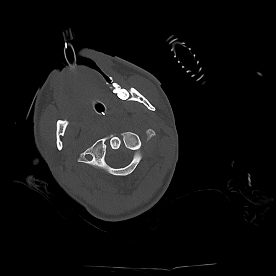 Atlanto-occipital dissociation (Traynelis type 1), C2 teardrop fracture, C6-7 facet joint dislocation (Radiopaedia 87655-104061 Axial bone window 23).jpg