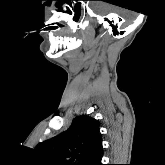 Atlanto-occipital dissociation (Traynelis type 1), C2 teardrop fracture, C6-7 facet joint dislocation (Radiopaedia 87655-104061 D 25).jpg