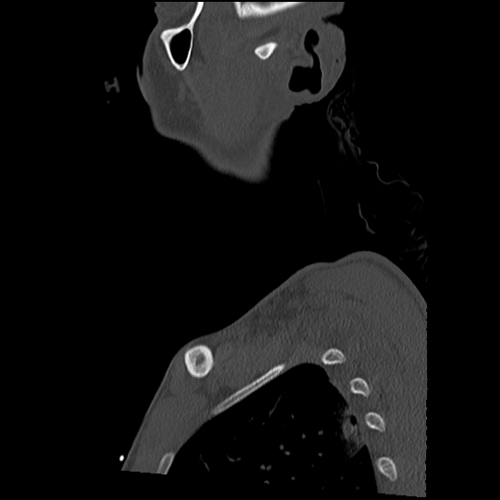 File:Atlanto-occipital dissociation (Traynelis type 1), C2 teardrop fracture, C6-7 facet joint dislocation (Radiopaedia 87655-104061 Sagittal bone window 1).jpg