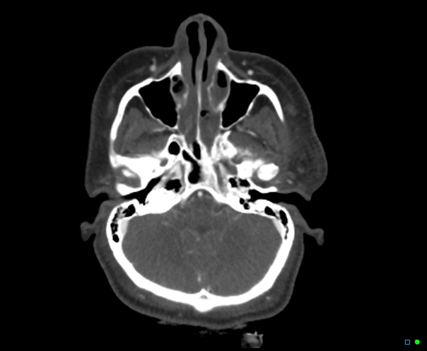 Atlanto-occipital dissociation - Traynelis type 1 (Radiopaedia 87570-103949 A 61).jpg