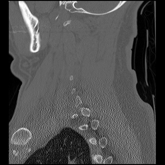 Atlanto-occipital dissociation injury (Radiopaedia 29274-29698 Sagittal bone window 45).png
