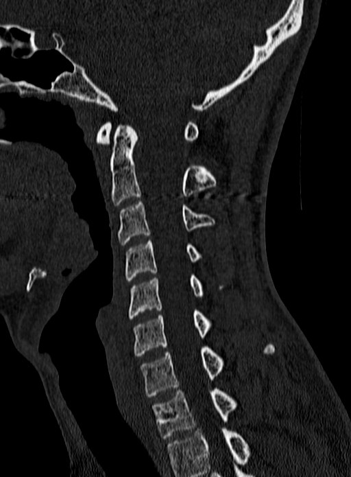 Atlantoaxial subluxation (Radiopaedia 44681-48450 Sagittal bone window 65).jpg