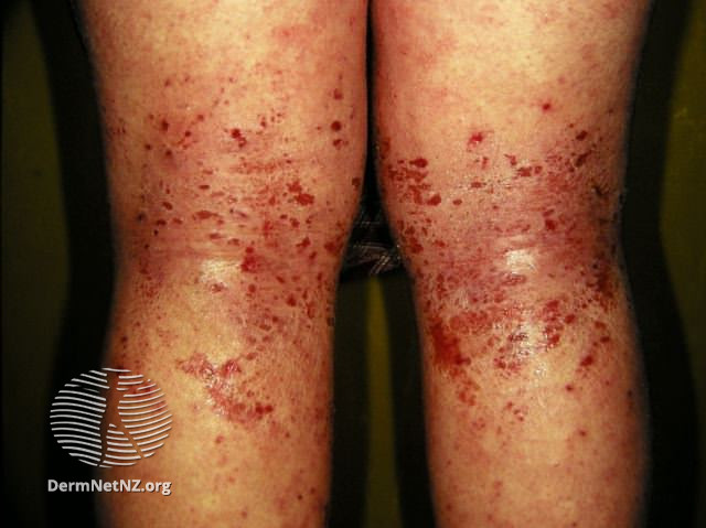 File:Atopic dermatitis (DermNet NZ dermatitis-flexural-eczema17).jpg