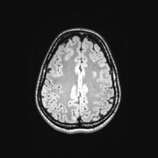 Atretic encephalocoele with inferior vermis hypoplasia (Radiopaedia 30443-31108 Axial 118).jpg