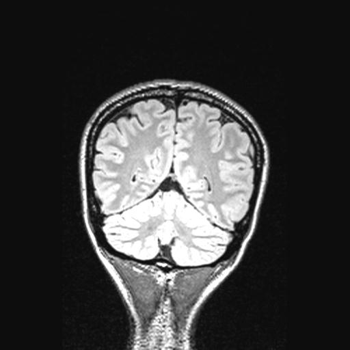 Atretic encephalocoele with inferior vermis hypoplasia (Radiopaedia 30443-31108 Coronal FLAIR 49).jpg
