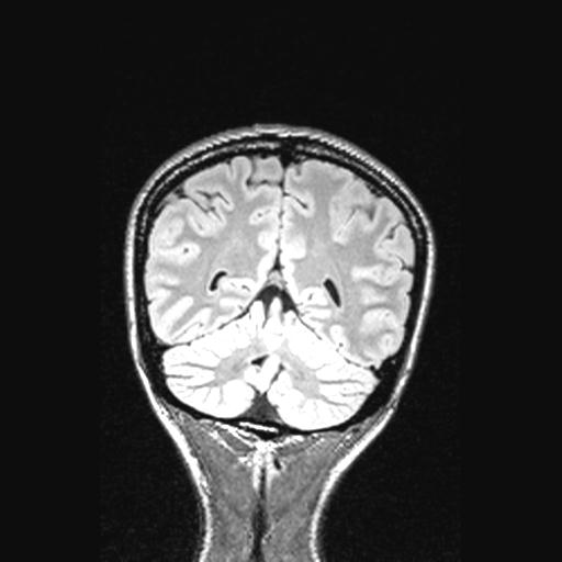 File:Atretic encephalocoele with inferior vermis hypoplasia (Radiopaedia 30443-31108 Coronal FLAIR 53).jpg