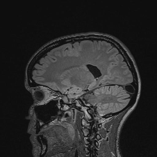 Atretic encephalocoele with inferior vermis hypoplasia (Radiopaedia 30443-31108 Sagittal FLAIR 98).jpg