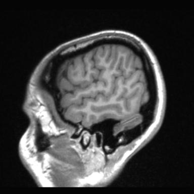 Atretic encephalocoele with inferior vermis hypoplasia (Radiopaedia 30443-31108 Sagittal T1 117).jpg
