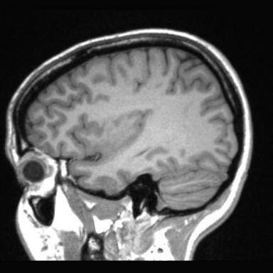 File:Atretic encephalocoele with inferior vermis hypoplasia (Radiopaedia 30443-31108 Sagittal T1 32).jpg