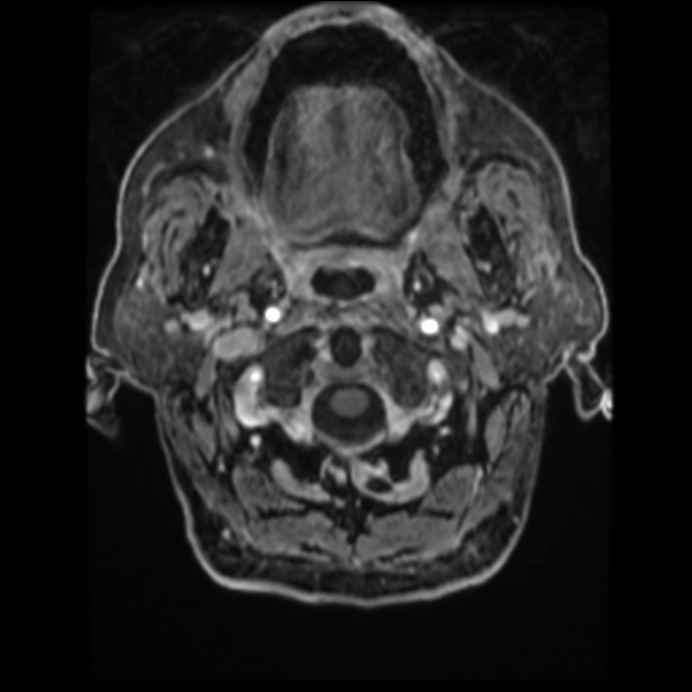 Atypical meningioma (Radiopaedia 45535-49629 Axial T1 C+ 12).jpg