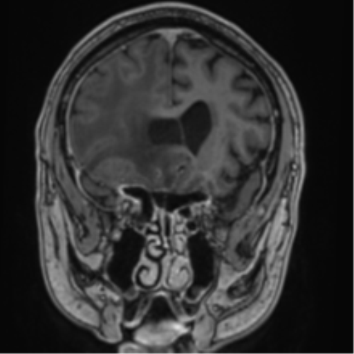 File:Atypical meningioma (WHO grade II) with brain invasion (Radiopaedia 57767-64729 Coronal T1 C+ 26).png