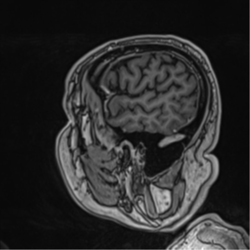 Atypical meningioma (WHO grade II) with brain invasion (Radiopaedia 57767-64729 Sagittal T1 C+ 17).png