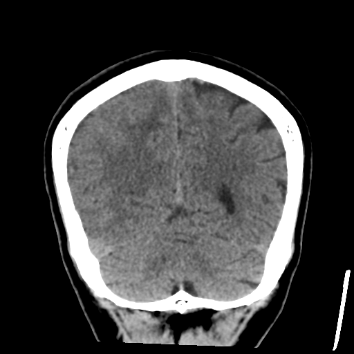 Atypical meningioma (WHO grade II) with osseous invasion (Radiopaedia 53654-59715 Coronal non-contrast 48).png