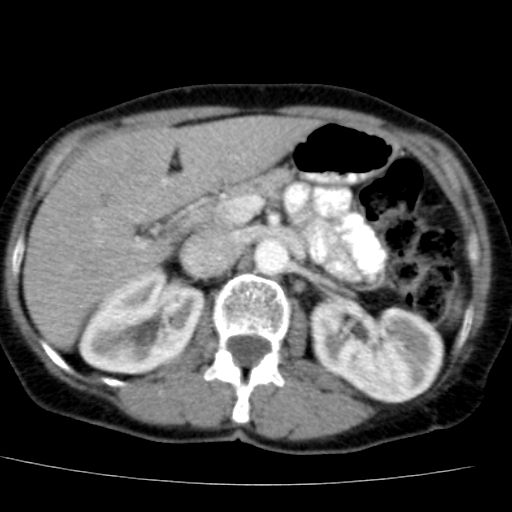 File:Atypical renal cyst (Radiopaedia 17536-17251 renal cortical phase 12).jpg