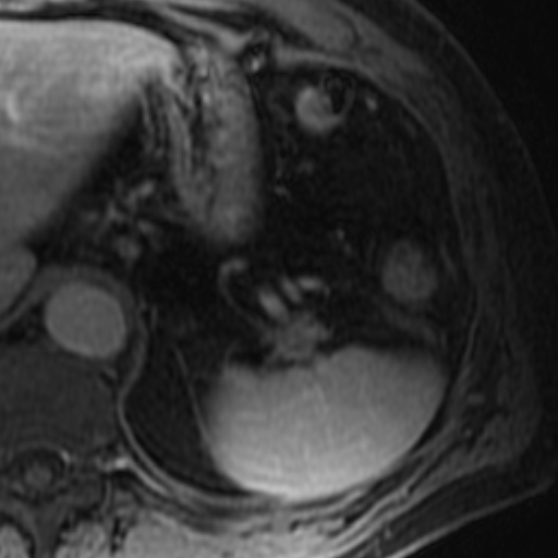 File:Atypical renal cyst on MRI (Radiopaedia 17349-17046 D 1).jpg