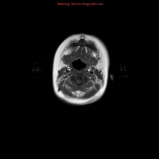 File:Atypical teratoid rhabdoid tumor (Radiopaedia 10712-11183 Axial T1 19).jpg