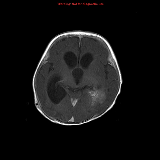File:Atypical teratoid rhabdoid tumor (Radiopaedia 10712-11183 Axial T1 C+ 10).jpg
