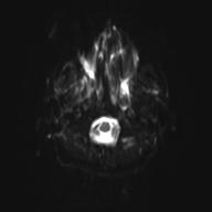 Autoimmune limbic encephalitis (Radiopaedia 30363-31005 Axial B0 and DWI 5).jpg