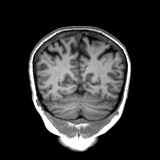 Autoimmune limbic encephalitis (Radiopaedia 30363-31005 Coronal T1 16).jpg