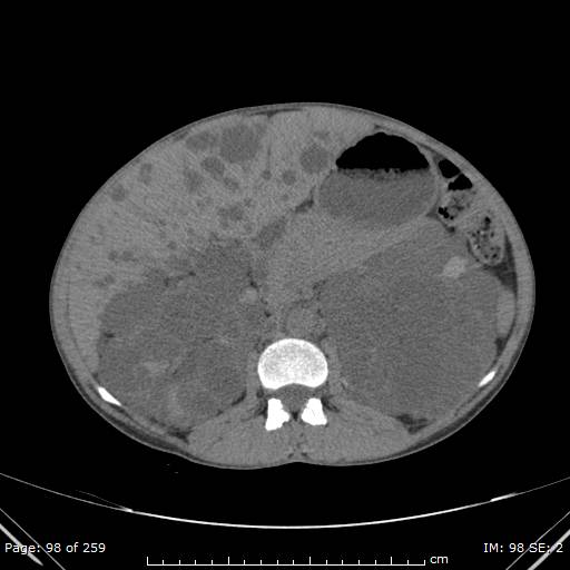 File:Autosomal dominant polycystic kidney disease (Radiopaedia 44122-47684 Axial 25).jpg