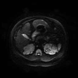 Autosomal dominant polycystic kidney disease (Radiopaedia 50259-55611 Axial DWI 89).jpg