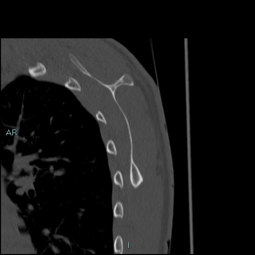 Avascular necrosis after fracture dislocations of the proximal humerus (Radiopaedia 88078-104653 Sagittal bone window 69).jpg