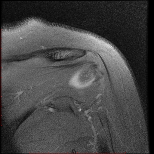 File:Avulsion fracture - greater tuberosity of humerus (Radiopaedia 25457-25703 Coronal PD 11).jpg