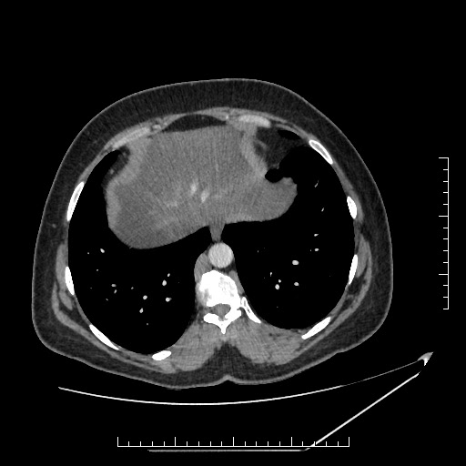 File:Azygos continuation of the IVC (Radiopaedia 40416-42965 A 6).jpg
