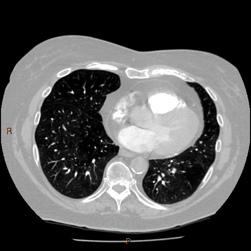 Azygos lobe (Radiopaedia 40161-42821 Axial lung window 48).jpg