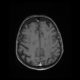 Balo concentric sclerosis (Radiopaedia 53875-59982 Axial LAVA C+ 186).jpg