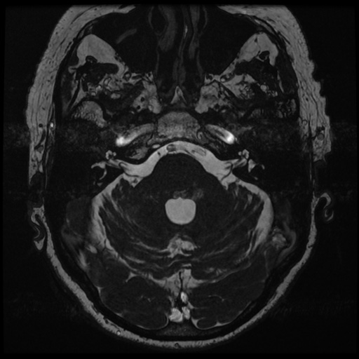 File:Balo concentric sclerosis (Radiopaedia 53875-59982 Axial T2 FIESTA 37).jpg