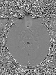 Base of skull chondrosarcoma (Radiopaedia 30410-31070 Axial SWI Phase 26).jpg