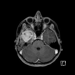 Base of skull rhabdomyosarcoma (Radiopaedia 32196-33142 T1 C+ fat sat 33).jpg
