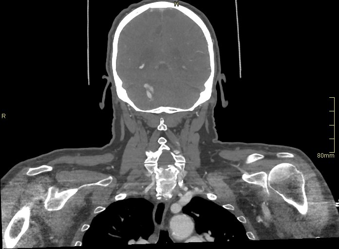File:Basilar artery aneurysm (Radiopaedia 56261-62932 B 49).jpg