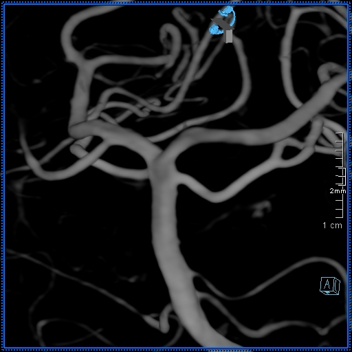 File:Basilar artery perforator aneurysm (Radiopaedia 82455-99524 3D Left VA 37).jpg