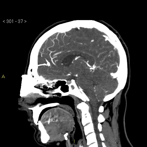 Basilar artery thrombosis (Radiopaedia 16260-15944 C 31).jpg