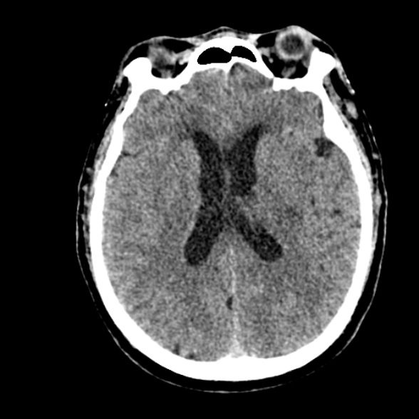 File:Basilar artery thrombosis (Radiopaedia 53351-59352 Axial non-contrast 70).jpg